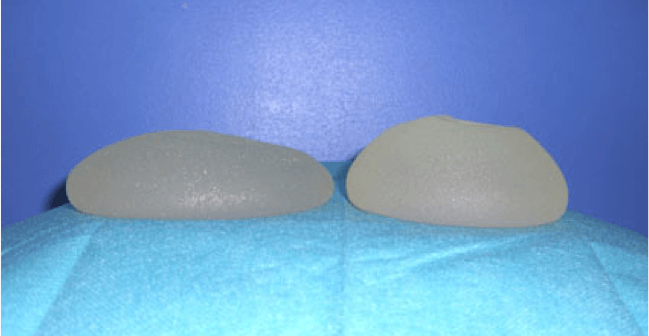 Implant mammaire pour une augmentation mammaire : ronds ou anatomiques ?